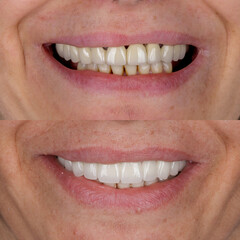 Full mouth porcelain crown treatment in cosmetic dentistry. Correction of crooked and deformed...