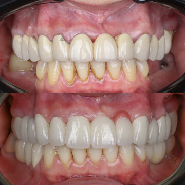 Smile design treatment with cosmetic dentistry. Laminate veneers and zirconia porcelain for a new smile through dental design. Dental before after and smile makeover.