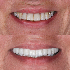 Fototapeta premium Full-arch denture prosthesis with dental implants placed in the jawbone. Full arch implant treatment with porcelain prosthesis. Dental before after and smile makeover.