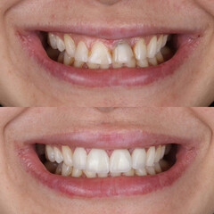 Full mouth porcelain crown treatment in cosmetic dentistry. Correction of crooked and deformed...