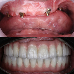 Bone level dental implants and full arch dental prosthesis in dentistry. Full mouth implant supported prosthesis for edentulous jaws. Dental before after and smile makeover.   © UniqDream