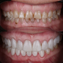 Dental design treatment in aesthetic dentistry. Full mouth smile makeover with glass ceramic porcelains. Dental veneers and bridge treatment. Dental before after and smile makeover.

