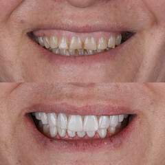Dental treatment in dentistry. Smile design treatment with dental design. New tooth design with...