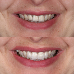 Obraz premium Dental treatment in dentistry. Smile design treatment with dental design. New tooth design with porcelain crowns. Full arch dental treatment. Dental before after and smile makeover.