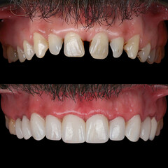 Treatment of all teeth in the mouth with porcelain crowns in dentistry. Smile design treatment. Smile makeover with digital dentistry. Dental before after. © UniqDream