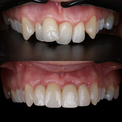 Treatment of all teeth in the mouth with porcelain crowns in dentistry. Smile design treatment. Smile makeover with digital dentistry. Dental before after. © UniqDream