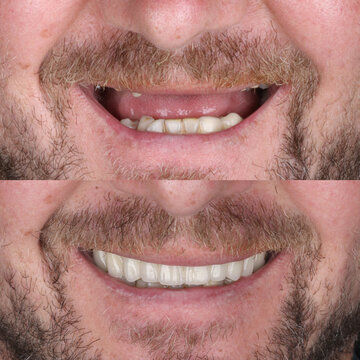 Bone level dental implants and full arch dental prosthesis in dentistry. Full mouth implant supported prosthesis for edentulous jaws. Dental before after and smile makeover.

