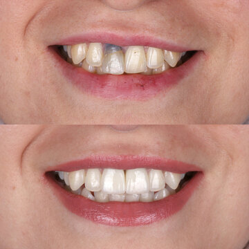 Treatment of front incisors with dental implants through oral surgery. Implant treatment of anterior aesthetic zone with E-Max and zirconia porcelain. Dental before after.

