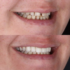 Treatment of all teeth in the mouth with porcelain crowns in dentistry. Smile design treatment. Smile makeover with digital dentistry. Dental before after. © UniqDream