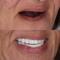 Bone level dental implants and full arch dental prosthesis in dentistry. Full mouth implant supported prosthesis for edentulous jaws. Dental before after and smile makeover.   © UniqDream