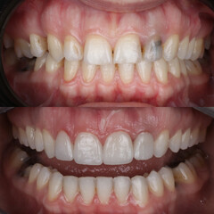 Treatment of all teeth in the mouth with porcelain crowns in dentistry. Smile design treatment. Smile makeover with digital dentistry. Dental before after. © UniqDream