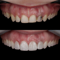 Treatment of all teeth in the mouth with porcelain crowns in dentistry. Smile design treatment. Smile makeover with digital dentistry. Dental before after. © UniqDream