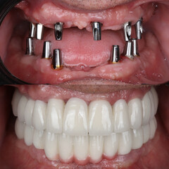 Dental implant treatment with oral surgery. Treatment of tooth loss. Porcelain dental prosthesis...