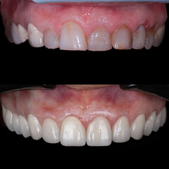 Treatment of all teeth in the mouth with porcelain crowns in dentistry. Smile design treatment. Smile makeover with digital dentistry. Dental before after. © UniqDream