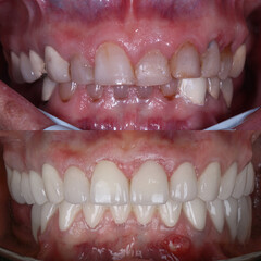 Dental design treatment in aesthetic dentistry. Full mouth smile makeover with glass ceramic porcelains. Dental veneers and bridge treatment. Dental before after and smile makeover.   © UniqDream