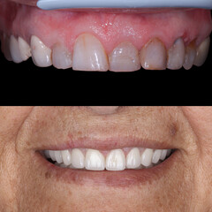 Dental design treatment in aesthetic dentistry. Full mouth smile makeover with glass ceramic porcelains. Dental veneers and bridge treatment. Dental before after and smile makeover.   © UniqDream