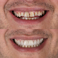 Treatment of all teeth in the mouth with porcelain crowns in dentistry. Smile design treatment. Smile makeover with digital dentistry. Dental before after. © UniqDream
