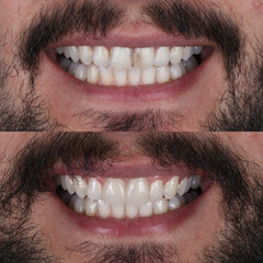Dental design treatment in aesthetic dentistry. Full mouth smile makeover with glass ceramic porcelains. Dental veneers and bridge treatment. Dental before after and smile makeover.   © UniqDream