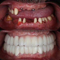 Bone level dental implants and full arch dental prosthesis in dentistry. Full mouth implant supported prosthesis for edentulous jaws. Dental before after and smile makeover.   © UniqDream