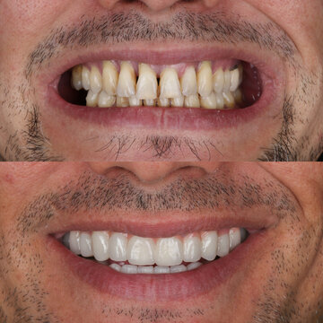 Dental implant treatment with oral surgery. Treatment of tooth loss. Porcelain dental prosthesis placed on implants embedded in the jawbone. Dental before after and smile makeover.

