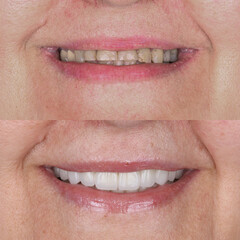 Treatment of all teeth in the mouth with porcelain crowns in dentistry. Smile design treatment. Smile makeover with digital dentistry. Dental before after. © UniqDream