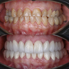 Dental treatment in dentistry. Smile design treatment with dental design. New tooth design with porcelain crowns. Full arch dental treatment. Dental before after and smile makeover.   © UniqDream