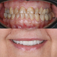 Treatment of all teeth in the mouth with porcelain crowns in dentistry. Smile design treatment. Smile makeover with digital dentistry. Dental before after. © UniqDream