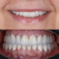Dental design treatment in aesthetic dentistry. Full mouth smile makeover with glass ceramic porcelains. Dental veneers and bridge treatment. Dental before after and smile makeover.   © UniqDream