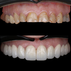Treatment of all teeth in the mouth with porcelain crowns in dentistry. Smile design treatment. Smile makeover with digital dentistry. Dental before after. © UniqDream