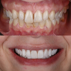 Treatment of all teeth in the mouth with porcelain crowns in dentistry. Smile design treatment. Smile makeover with digital dentistry. Dental before after. © UniqDream