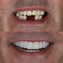 Bone level dental implants and full arch dental prosthesis in dentistry. Full mouth implant supported prosthesis for edentulous jaws. Dental before after and smile makeover.   © UniqDream