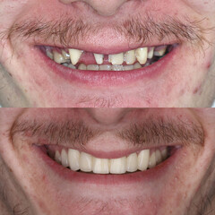 Treatment of all teeth in the mouth with porcelain crowns in dentistry. Smile design treatment. Smile makeover with digital dentistry. Dental before after. © UniqDream
