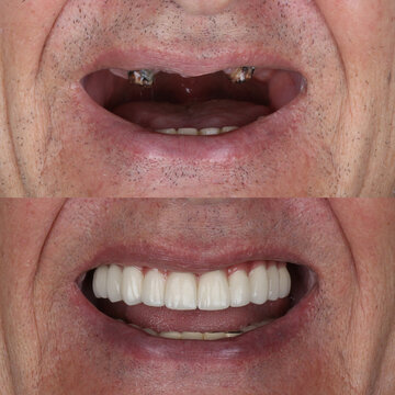 Bone level dental implants and full arch dental prosthesis in dentistry. Full mouth implant supported prosthesis for edentulous jaws. Dental before after and smile makeover.

