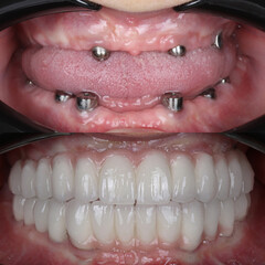 Bone level dental implants and full arch dental prosthesis in dentistry. Full mouth implant supported prosthesis for edentulous jaws. Dental before after and smile makeover.   © UniqDream