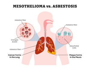 Mesothelioma Lung vs Asbestosis Lung, educational medical poster design healthcare scheme, human lung disease internal organs. Labeled plaque forms in pleura, asbestosis fiber. 