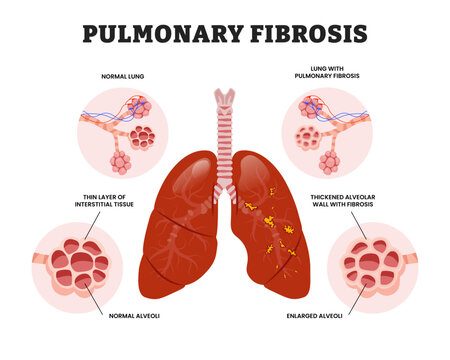 pulmonary fibrosis, pulmonary, fibrosis, interstitial lung disease, interstitial, anatomy, human, internal, organ, part, lung, lungs, respiratory system, respiratory, system, trachea, respiration, bro