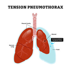 Tension Pneumothorax Lung, educational medical poster design healthcare scheme, human lung disease internal organs. Labeled collapsed lung, bronchial rupture, trapped air leaks.
