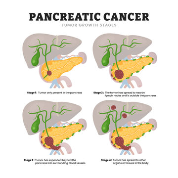 Pancretic Cancer Tumor Growth Stages Development Process, educational medical poster design healthcare scheme, human pancreas disease internal organs. Labeled Tumor spreads pancreas organ tissue.