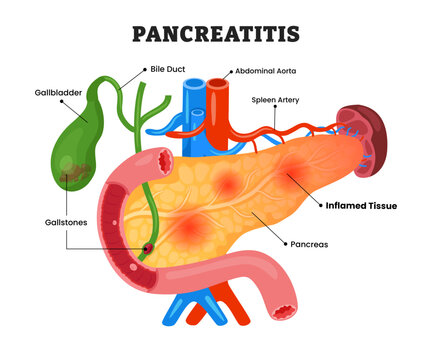 Pancreatitis or Pancreas Inflammation, educational medical poster design healthcare scheme, human pancreas disease internal organs. Labeled gallstones, inflamed tissue, bile duct.