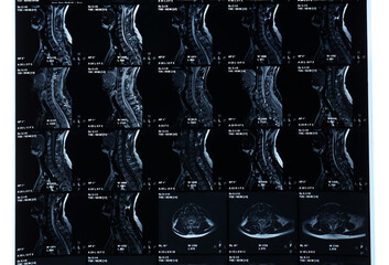 MRI scan of spine on white background