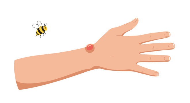Hand with bee sting on skin and bee flying nearby  