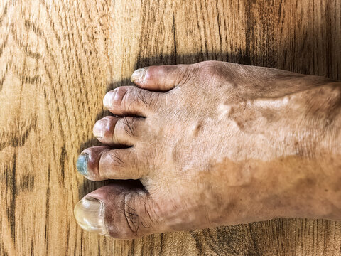 Subungual hematoma blue black toenail. Subungual hematoma under long toe or pointer toe. Subungual hematoma is when blood forms under fingernail or toenail. Feet of man with black nail. Nail disease.