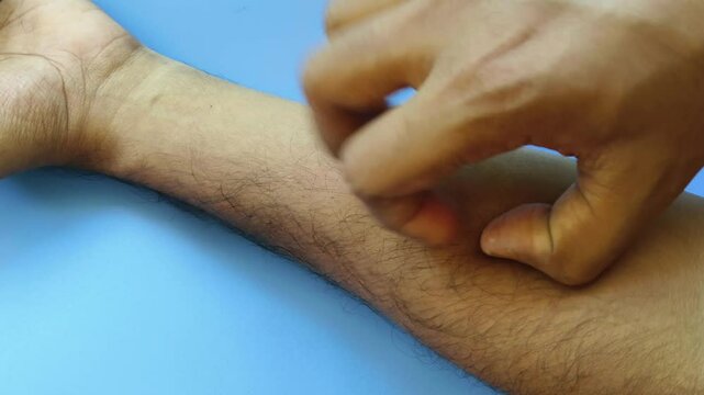 Closeup of young adult hand scratching itchy arm skin. Fungal disease, rash itching, body discomfort, atopic, eczema, pruritus and allergy irritation concept.