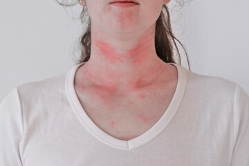 Allergic skin reaction on the female neck and face