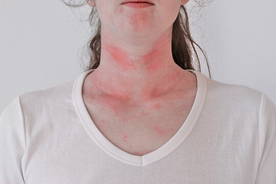 Allergic skin reaction on the female neck and face