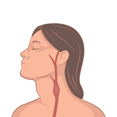 Medical illustration of a female patient with a thrombosis in the jugular vein on the side of the neck.