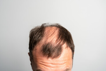 Close-up balding head of a young man on a on gray isolated background.