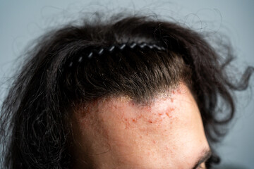 Close-up of a person s forehead with acne and irritation along the hairline, wearing a black...