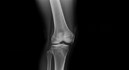 Knee joint Xray skeletal visibility