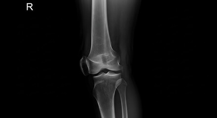 Right knee joint radiograph image